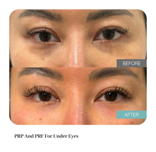 Before and after treatment result — Dr. Lanna, LC Medical Aesthetics NYC
